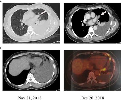 Molecular Characteristics of Genes and the Immune Microenvironment of a Rare Chest Malignant Tumor (Pulmonary Clear Cell Sarcoma): A Case Report